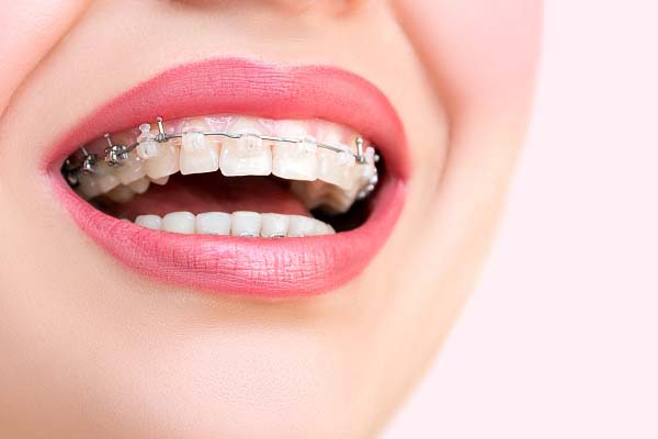 A Step By Step Process Of How Braces Work